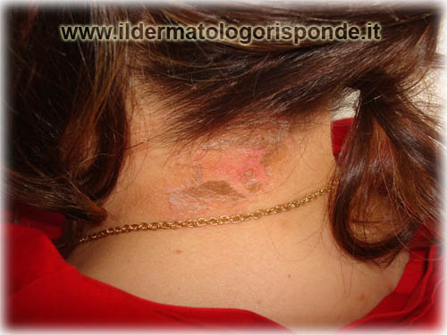 Medicina e cura di psoriasi